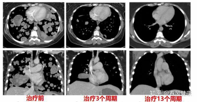 癌癥治療新突破，重塑生命之光之旅